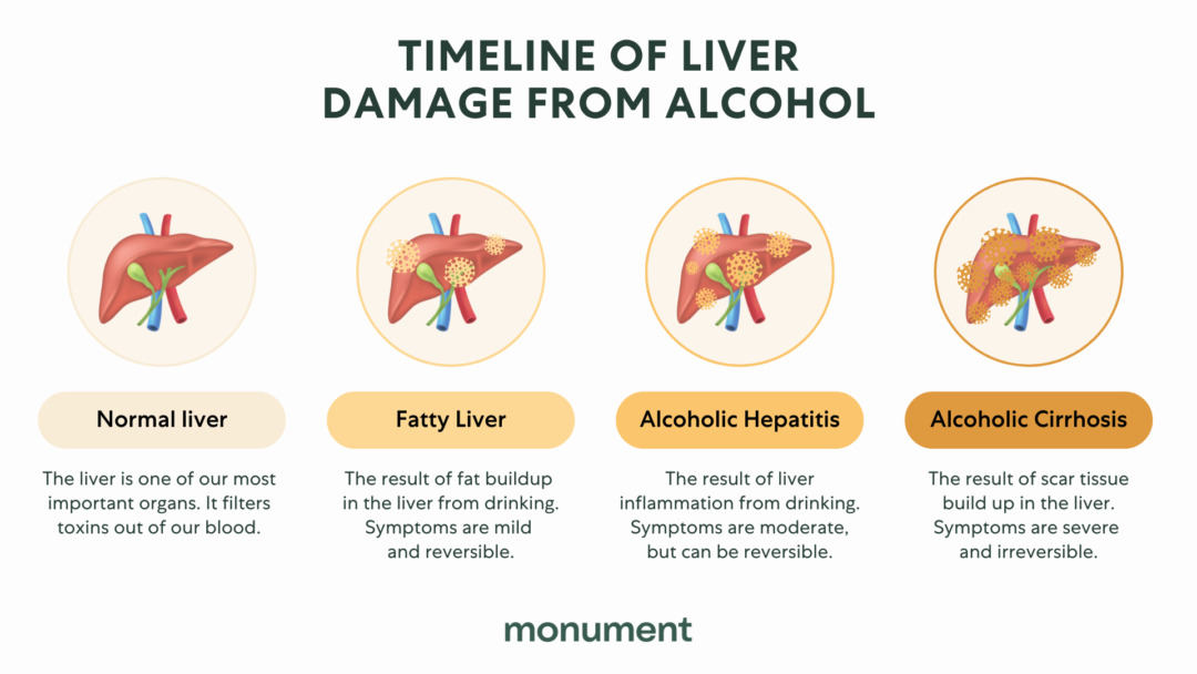 "Timeline of liver damage from alcohol. Normal liver: the liver is one of our most important organs. It filters toxins out of our blood. Fatty liver: the result of fat buildup in the liver from drinking. Symptoms are mild and reversible. Alcoholic hepatitis: the result of liver inflammation from drinking. Symptoms are moderate, but can be reversible. Alcoholic cirrhosis: the result of scar tissue build up in the liver. Symptoms are severe and irreversible."